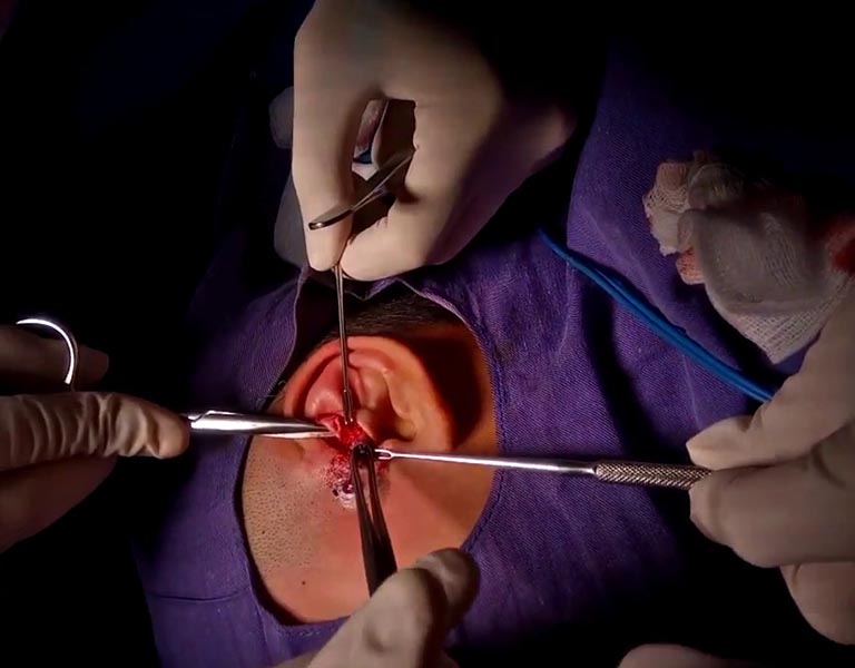 Phẫu thuật rò luân nhĩ được chỉ định với các bệnh nhân bị viêm nhiễm hoặc thường xuyên tái phát