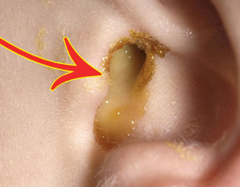 Thủng màng nhĩ có thể dẫn tới biến chứng nhiễm trùng tai giữa
