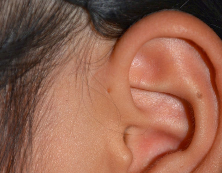 Dấu hiệu nhận biết căn bệnh là lỗ nhỏ bằng đầu tăm ở cạnh vành tai