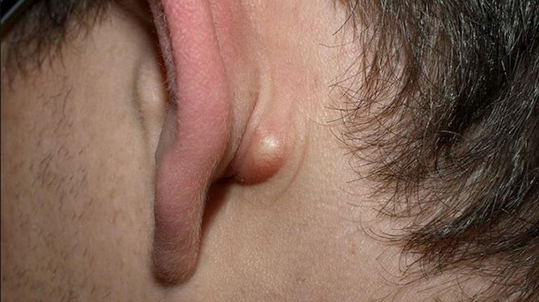 U bã đậu ở tai là dạng u lành tính thường gặp ở nhiều đối tượng khác nhau