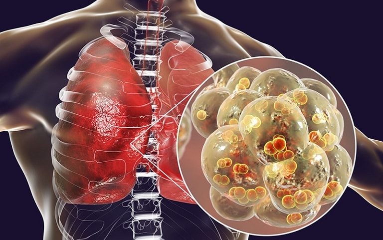 Viêm phổi là biến chứng nghiêm trọng của viêm amidan hốc mủ