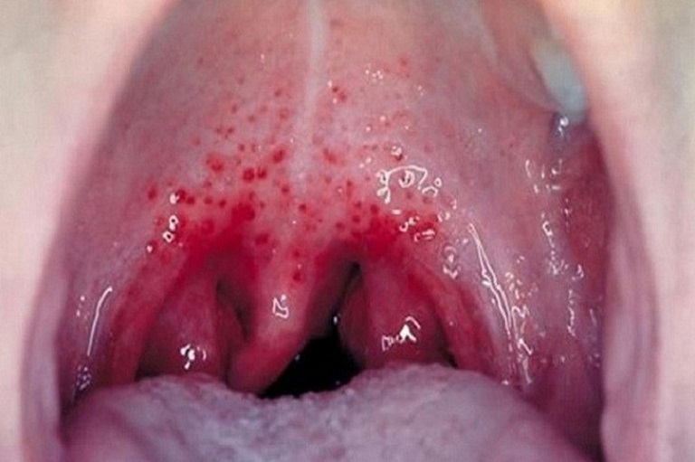 Ung thư vòm họng là biến chứng nguy hiểm nhất của viêm họng hạt mãn tính