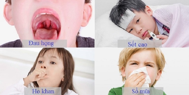 Viêm mũi họng có triệu chứng thường thấy như: Đau họng, sốt cao, ho,...