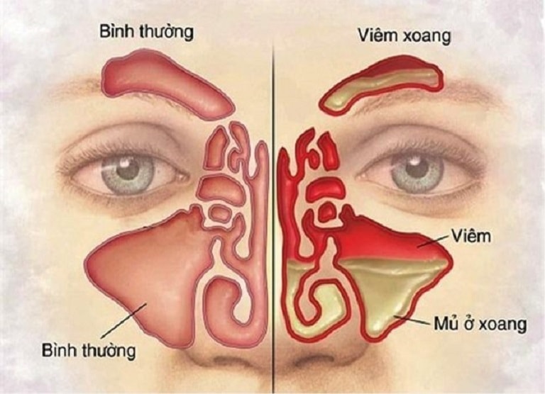 Niêm mạc mũi sưng đỏ và xoang chứa đầy dịch là các triệu chứng của bệnh viêm mũi xoang cấp