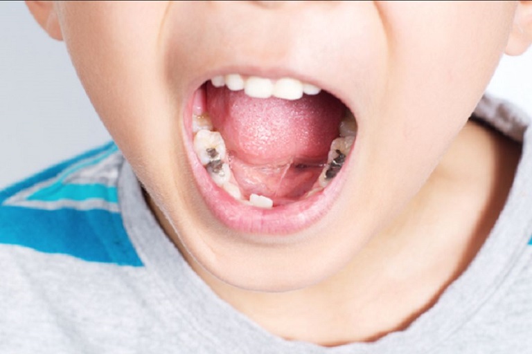 Viêm xoang hàm có liên quan đến răng thường khá phổ biến