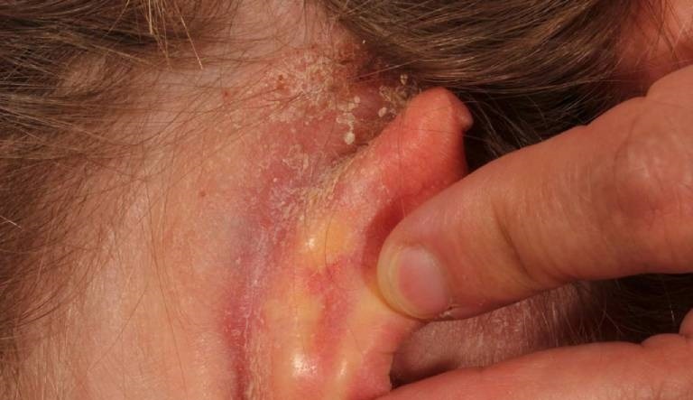 Bệnh chàm tai gây bong tróc da ở vùng tai ngoài