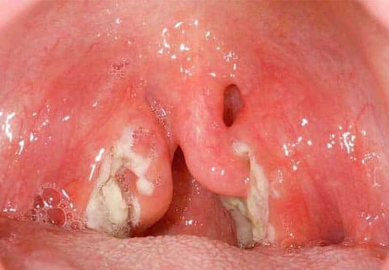 Hình ảnh các dịch mủ trắng tại vùng họng khi bị viêm amidan hốc mủ