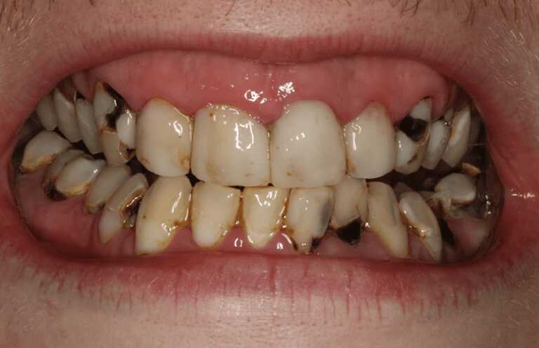 Sâu răng là một trong những nguyên nhân chính gây bệnh viêm amidan có mủ