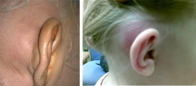 Viêm tai xương chũm có thể xảy ra ở cả người lớn và trẻ nhỏ