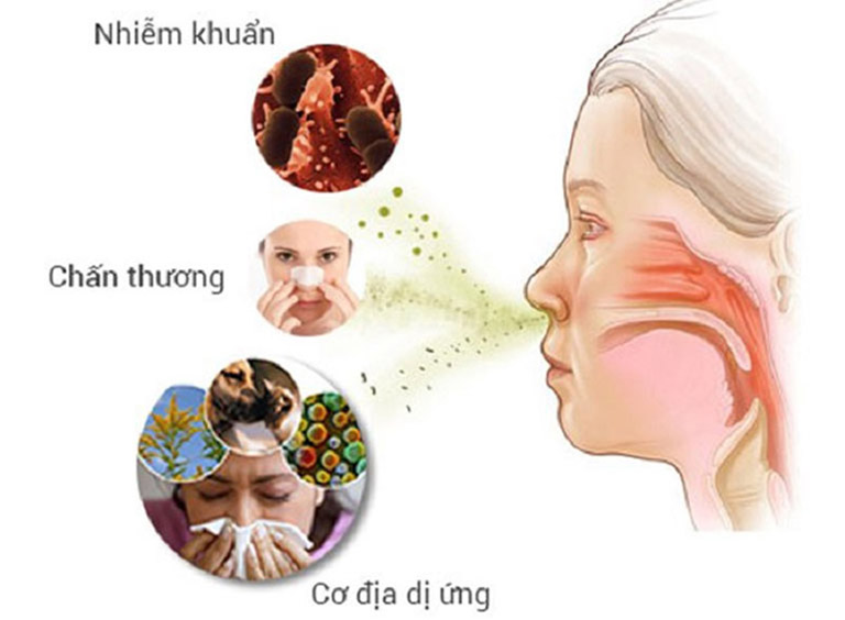 Nguyên nhân gây viêm mũi dị ứng bội nhiễm bao gồm cả yếu tố chủ quan và khách quan tác động
