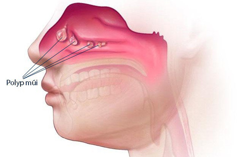 Polyp mũi xoang là một dạng u lành rất hay gặp